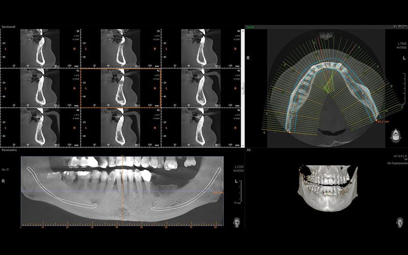 Planos a estudiar en un escáner CBCT