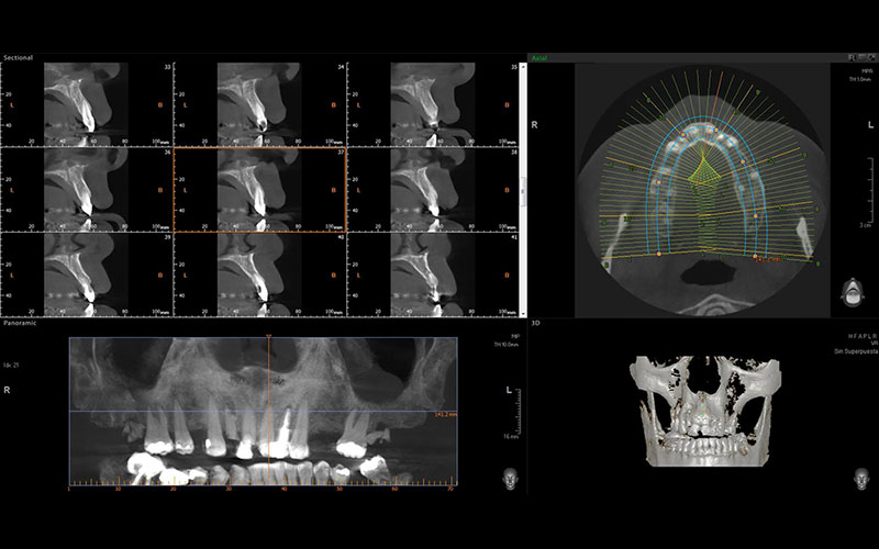 Planos y marcación de dentados