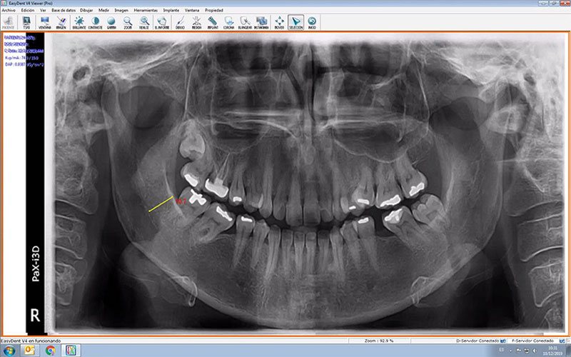 Precisión en la medición de las ortopantomografías