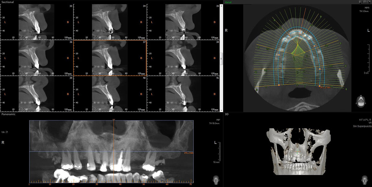 Escáner CBCT 3D