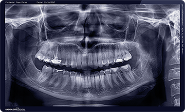 Ortopantomografía digital impresa